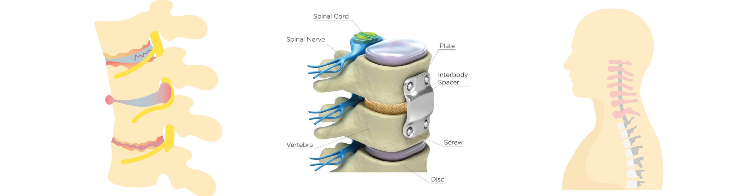 Cervical spine anatomy and disc replacement diagram