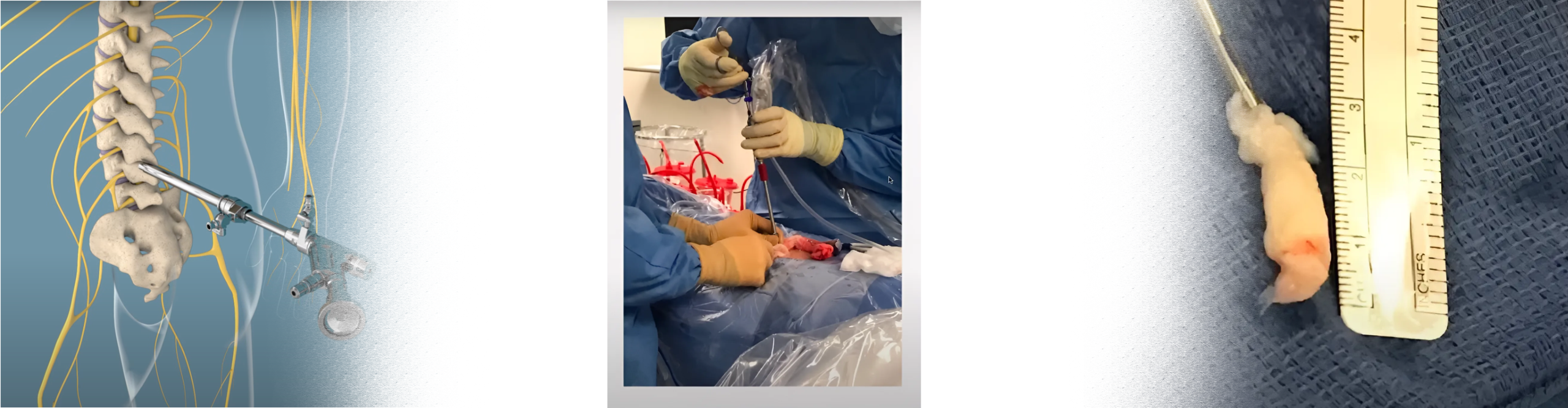 Endoscopic Spine Surgery